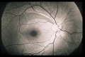 (cliccare) Fig. 2: Un difetto denso cuneiforme, ma ristretto, del RNFL, localizzato nello strato superiore delle fibre nervose arcuate dell'occhio destro di un paziente di 53 anni. La normalità di altre aree del fondo oculare è identificabile dal riflesso bianco dei fasci di assoni.