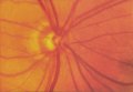 (cliccare) Fig. 3: Fotografia della papilla in occhi con glaucoma. Occhi con alterazione glaucomatosa precoce della papilla. Il bordo neuroretinico ha perso la sua forma normale; essa è diventata più o meno uguale come estensione su tutto il contorno papillare (vedi testo).