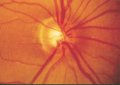 (cliccare) Fig. 4: Fotografia della papilla in occhi con glaucoma. Occhi con alterazione glaucomatosa precoce della papilla. Il bordo neuroretinico ha perso la sua forma normale; essa è diventata più o meno uguale come estensione su tutto il contorno papillare (vedi testo).