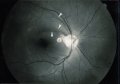 (cliccare) Fig. 5b:  Fotografia della papilla in occhi con glaucoma. Occhio glaucomatoso senza apparenti lesioni papillari ma con difetti localizzati (frecce) dello strato delle fibre nervose retiniche.