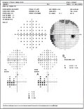 (cliccare) Fig. 3: Salto nasale evidenziato particolarmente da una mappa di probabilità di deviazione dal modello normale (A) con conseguente anormalità del Glaucoma Hemifield Test (B).
