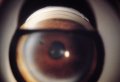 (cliccare) Fig. 4: Aspetto dell'angolo in un caso di glaucoma da chiusura d'angolo cronicizzato. La transizione tra angolo aperto e chiuso è chiaramente visibile.
