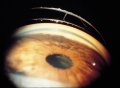 (cliccare)  Fig. 5: Aumentata pigmentazione dell'angolo e materiale pseudoesfoliativo sul margine pupillare.